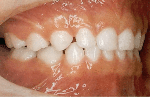 diastema 1